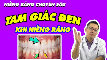 TAM GIÁC ĐEN KHI NIỀNG RĂNG? NGUYÊN NHÂN VÀ PHƯƠNG ÁN XỬ LÝ!!!