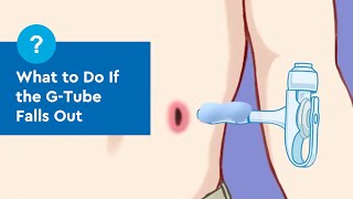 G-Tube Education: What to Do If the G-Tube Falls Out