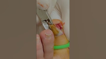 Will My Toenail Fall Off?