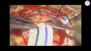 Opening the Arachnoid Membranes during Retromastoid Craniotomy (Preview)