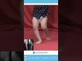 Girl with Congenital Patellar Dislocation and limb shortening started walking independent
