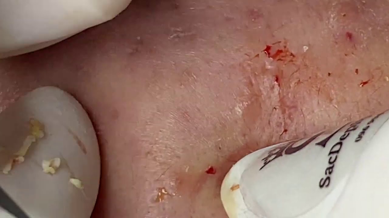 Extractions And Acne - ThuyTruong#80