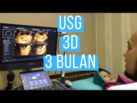 Video: 13 Minggu Kehamilan: Sensasi, Perkembangan Janin, Ultrasound