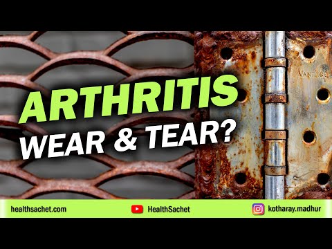 Osteoarthritis: The Joint 'Wear & Tear' Fallacy