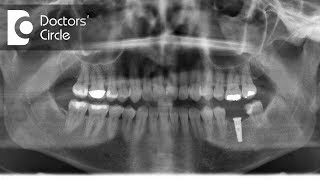 Are Dental Implants safe for MRI? Dr. Sharon Colaco Dias