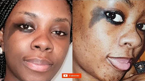 Comment se débarrasser des taches noires sur le visage naturellement