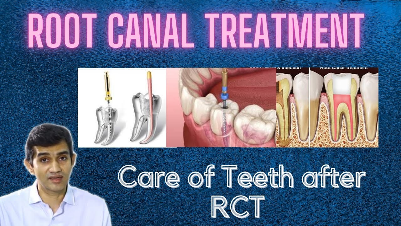 Care after Root Canal | Dr Arunkumar | Pearls Dentistry Dental Clinic ...