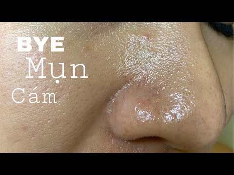 Cách Trị Mụn Cám Tận Gốc - BYE MỤN CÁM | TRỊ MỤN CÁM MỘT CÁCH NHANH CHÓNG ĐƠN GIẢN | Beni Beauty