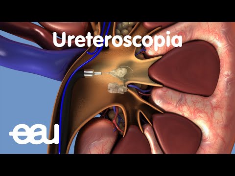 Vídeo: Passarà un càlcul renal de 6 mm?