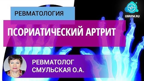 Ревматолог Смульская О.А.: Псориатический артрит
