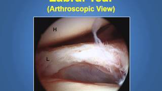Shoulder Instability and Dislocations Explained by an Arizona Orthopedic Surgeon (480) 219-3342