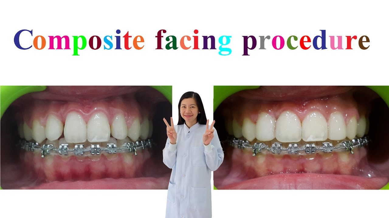 Composite facing procedure YouTube