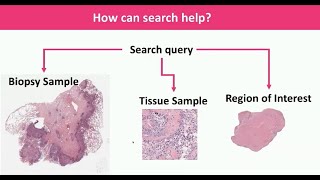 AI, Digital Pathology and Observer Variability: From Image Search to Building Diagnostic Consensus