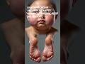 Nephrotic Syndrome  | Symptoms, Causes &amp; Treatment#nephroticsyndrome #shorts