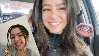 Getting My Braces Off After 4 YEARS! + braces q&a