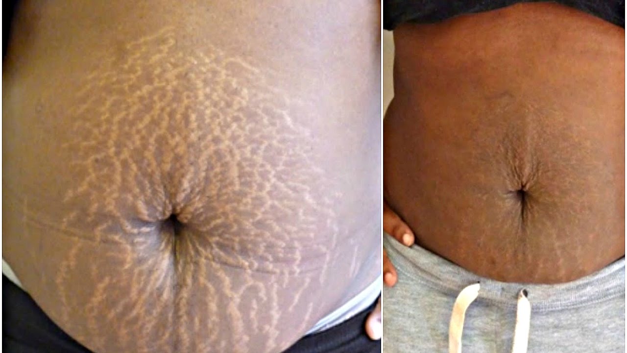 THIS POWERFUL TREATMENT WILL GET RID OF STRETCH MARKS IN 30 DAYS | AMAZING  FAST RESULTS