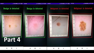 Real-time Skin Cancer (Melanoma) Detection Android App Using TFLite (GPU): Final Testing Part 4