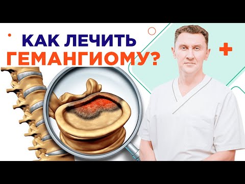 Как лечить гемангиому позвоночника правильно!Нейрохирург