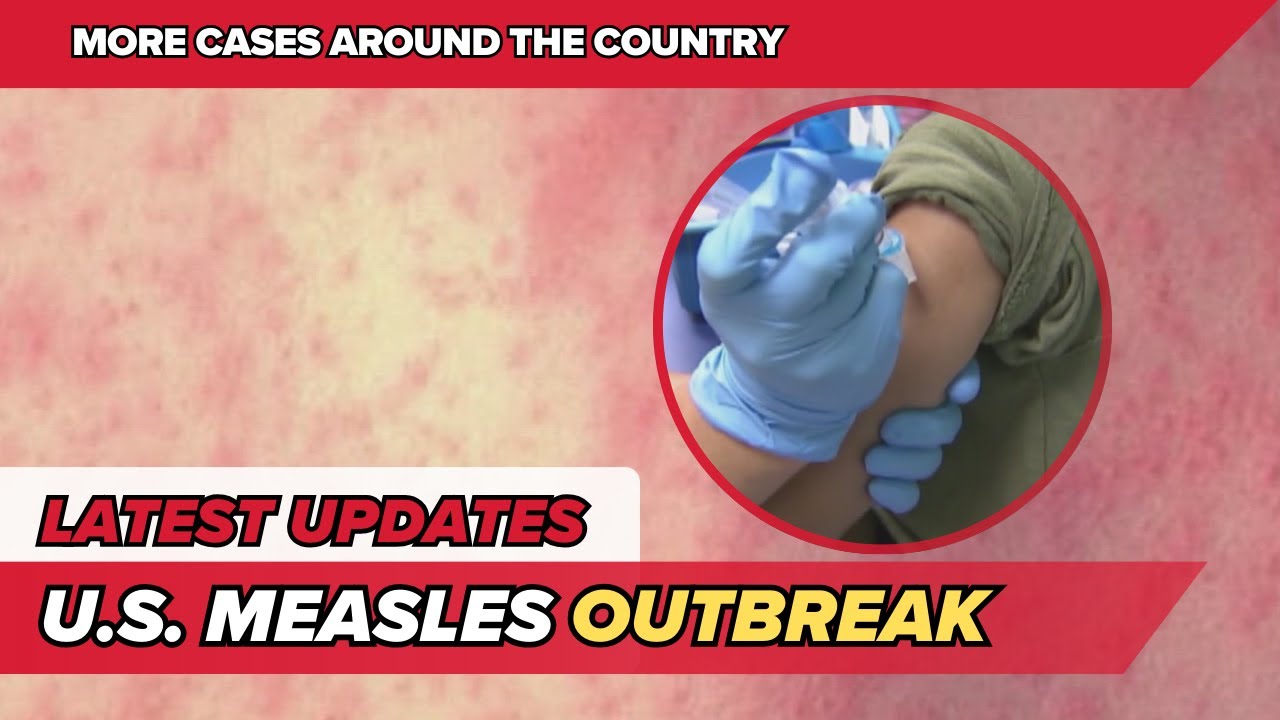 Measles outbreak 2026: What you need to know | UPDATES