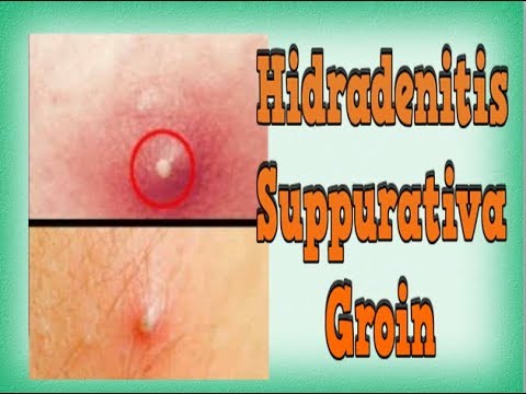 Hidradenitis Suppurativa Groin Hs Skin Disease Inflammation Of Sweat Glands Swollen Sweat Gland Youtube