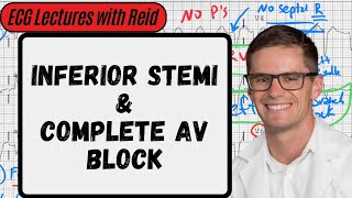 Inferior STEMI w/ Complete Heart Block | Day 27 ECG Challenge