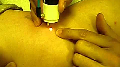 Quanta System-light Series-Veins video9.MOV