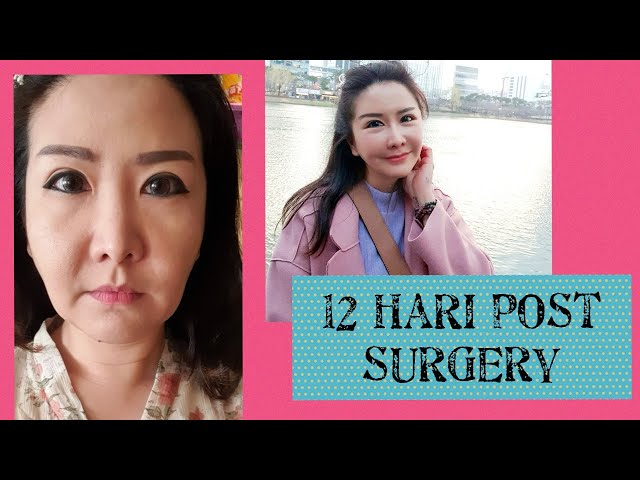 Update 12 hari Post Surgery | Olivia Rachelina Hans class=