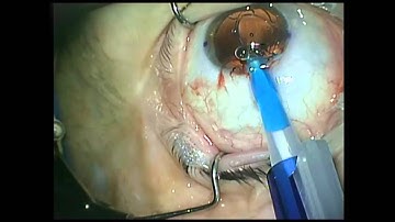 New Precizon Toric Loading Technique