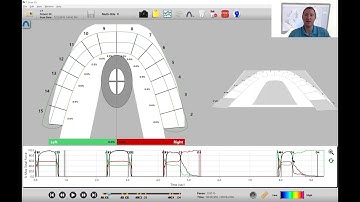 How to Know if You Have a Good, Repeatable T-Scan Recording
