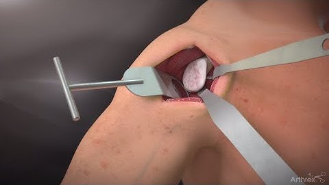 Univers Revers™ Modular Glenoid System - Monoblock Screw Configuration