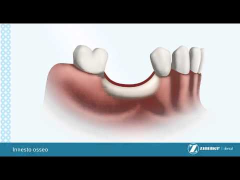 Video: Applicazione Di Bonelike® Come Innesto Osseo Sintetico In Chirurgia Ortopedica E Orale In Casi Clinici Veterinari