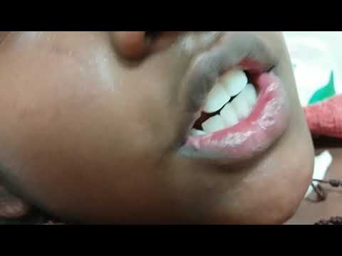 cerebellar speech video scanning speech in an child with cerebellar ataxia