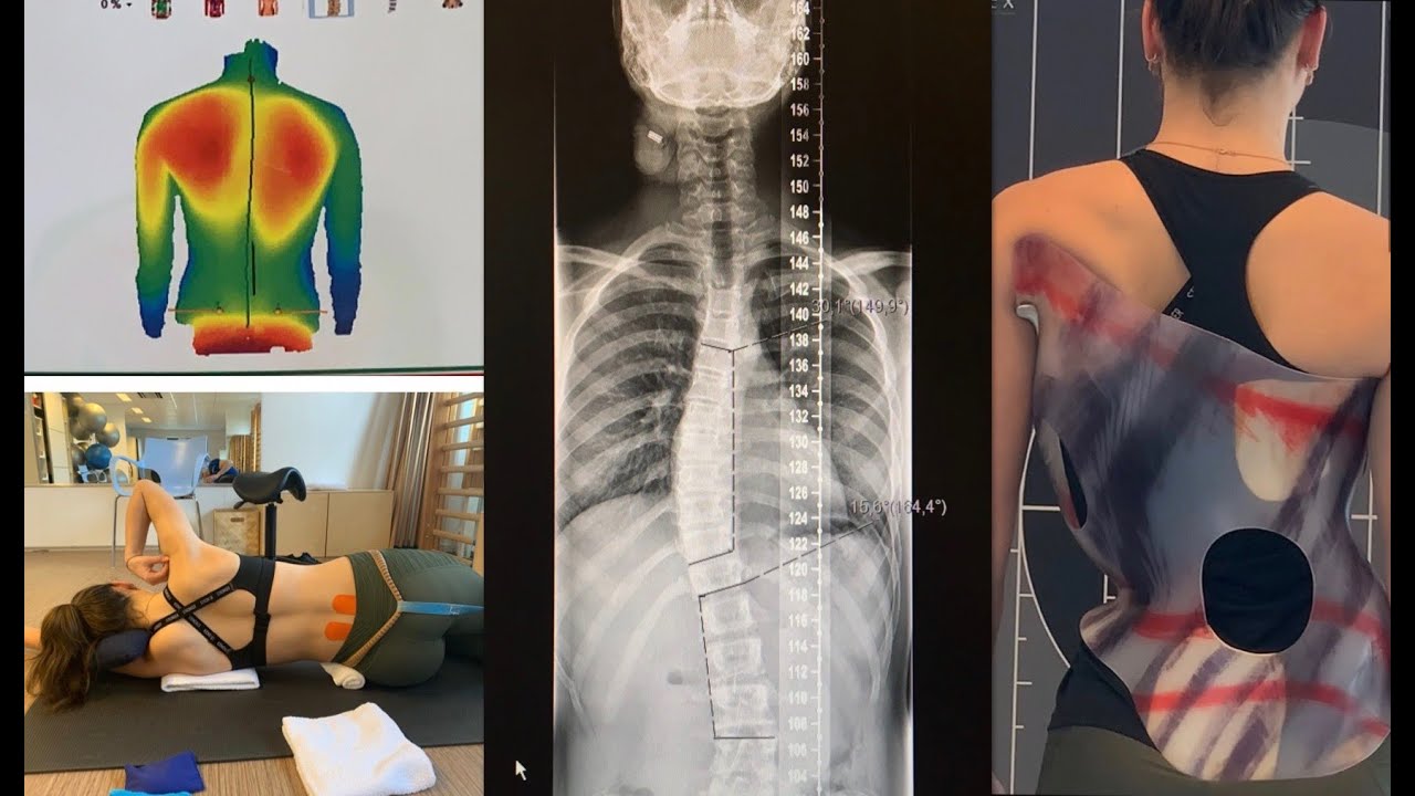 Mijn geheim: Mijn rug: SCOLIOSE ✰vlog 127✰ | Kristy Snepvangers |