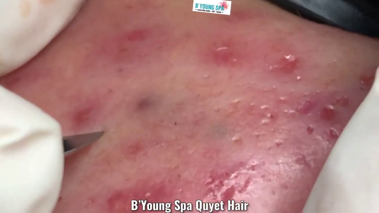 #205 | remove blackheads  @byoungspaquyethair2626