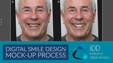 Digital Smile Design Mock-up Demonstration