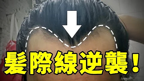 【发际线后移】导致发际线后移的原因有哪些？发际线后移如何改善？丨植发医生徐鲁 - 天天要闻