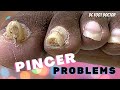 Pincer Problems: Feet and Back Related Issues Makes it Diifficult to Touch Her Toes