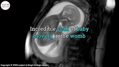 Incredibly detailed scan of baby moving in the womb