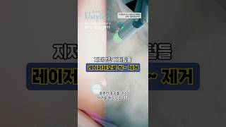 남자가슴제모 털 기강 잡고 자신감 업! #shorts #레이저제모