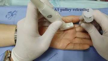 Ultrasound-guided percutaneous trigger finger release การใช้เข็มผ่าตัดนิ้วล็อคผ่านผิวหนัง