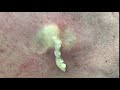 Cyst (Cream of Wheat) Removal