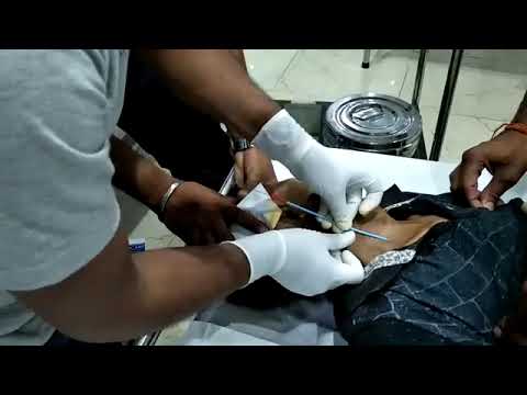 طريقة تركيب قسطره لمرضى فشل الكلوي