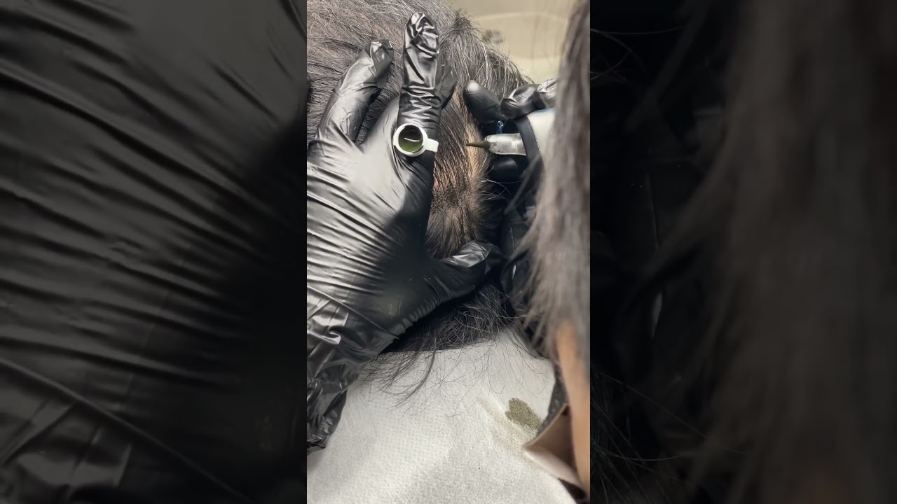 SCATTER Scalp Micropigmentation for Male Crown｜Before & After Comparison 