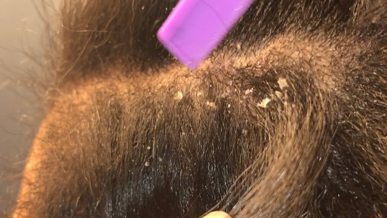 removing psoriasis plaques from scalp)
