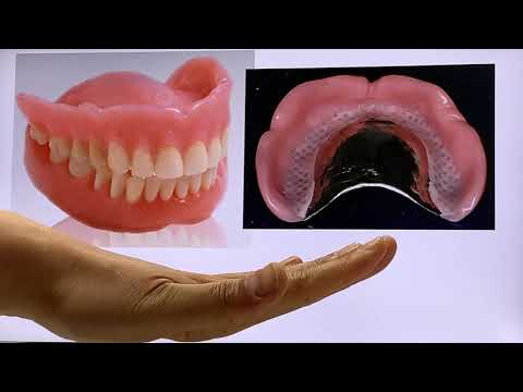 덴쳐(denture) 첨상(직접, 간접) & 개상의 차이