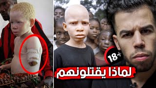 😯 هؤلاء الاطفال الافارقة بيض البشرة , يقتلونهم لأتفه سبب تتخيله