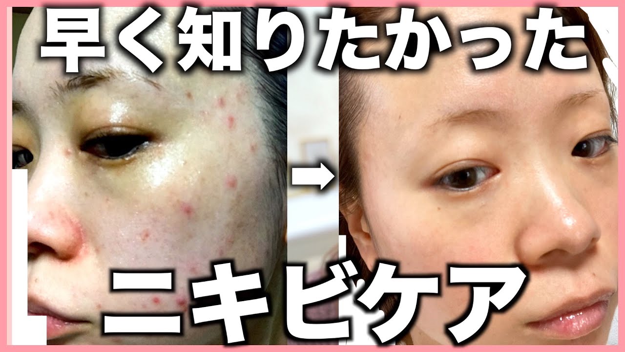 【ニキビ克服方法】本当に悩んでいる方へ。あらゆる方法を試してやっと見つけたニキビケア YouTube 【ニキビ克服方法】本当に悩んでいる方へ。あらゆる方法を試してやっと見つけたニキビケア YouTube