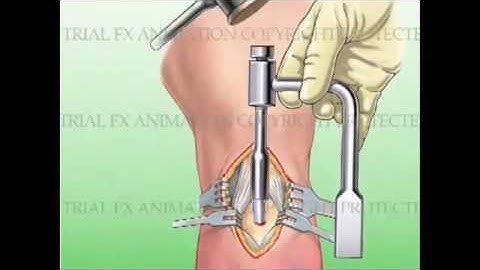 Fractura de tibia - Clavo Endomedular Con perno bloqueado- Rehabilitacion