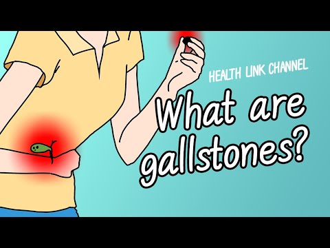 What is Gallbladder Stones?