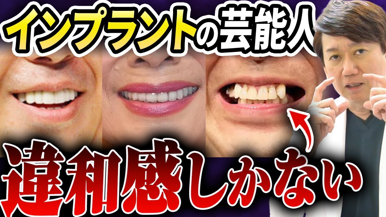 インプラント 失敗 芸能人